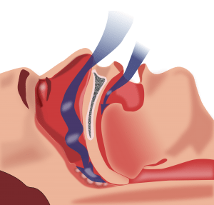 2000px-Obstruction_ventilation_apnée_sommeil_svg