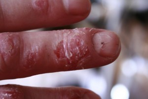 eczema-dry-skin-hands