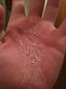eczema-hand
