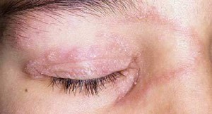 ringworm-on-eye