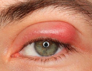 swollen-eyelid