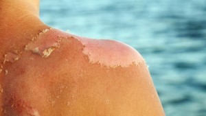 treat-peeling-sunburn_bbfe38a2354d498e