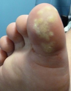 3-laser-plantar-wart-treatment