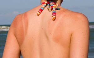 How-to-Get-Rid-of-Sunburn-Blisters-Treatment-and-Best-Home-Remedies