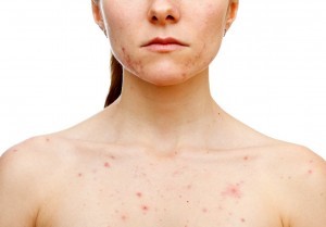 Skin-Diseases