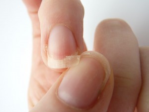 broken-nail