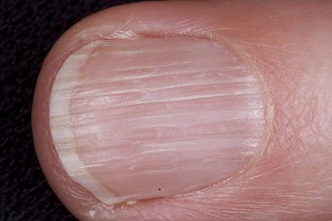 longitudinal-ridging-nails