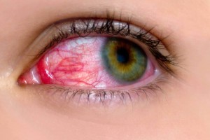 01-red-clear-signs-pink-eye-apichsn-25589704_medium