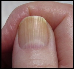 what-causes-vertical-or-horizontal-ridges-on-nails_2