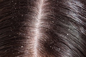 dandruff-and-dry-scalp-are-different-but-need-similar-treatment-1