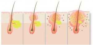 trait-acne-fig2