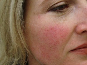 Cheek Broken Capillaries Laser Treatment - Before Photo